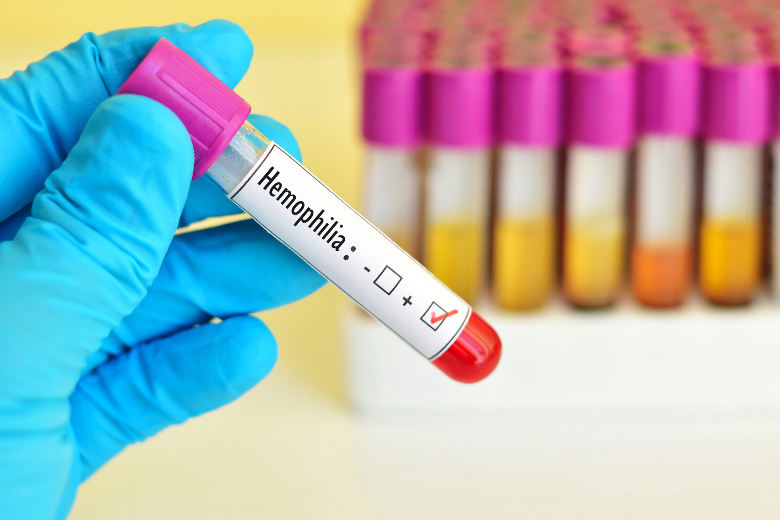 Gene therapy for haemophilia A with valoctogenic roxaparvovec shows very promising results